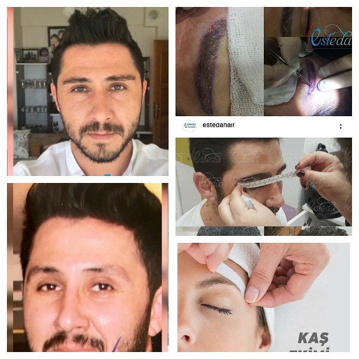 ¿Cómo se aplica el trasplante de cejas?