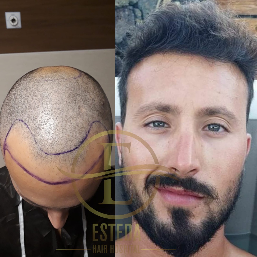 Saç Ekimi Öncesi Sonrası 10