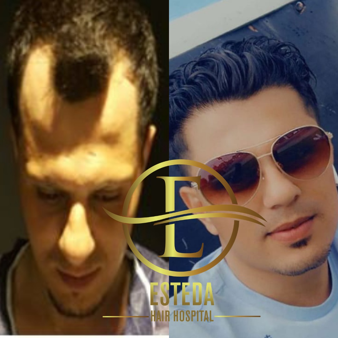 Saç Ekimi Öncesi Sonrası 3