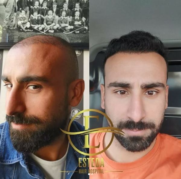 Saç Ekimi Öncesi Sonrası 10