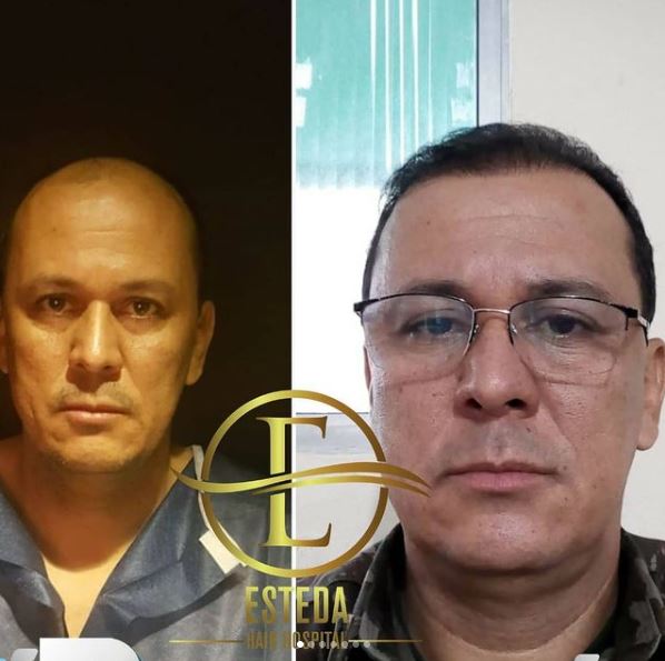 Saç Ekimi Öncesi Sonrası 11