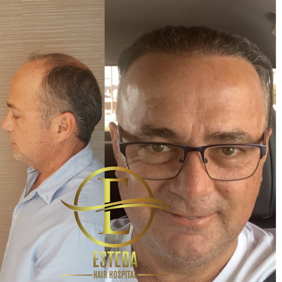 Saç Ekimi Öncesi Sonrası 16
