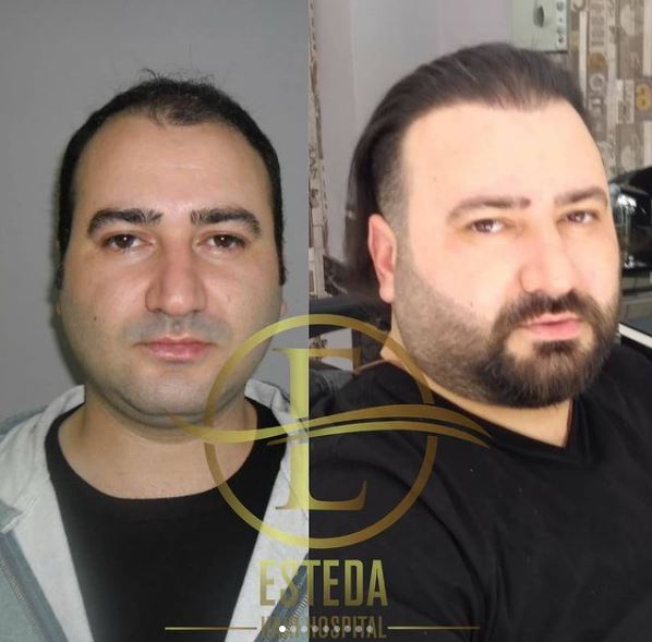 Saç Ekimi Öncesi Sonrası 23