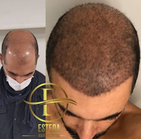 Saç Ekimi Öncesi Sonrası 3