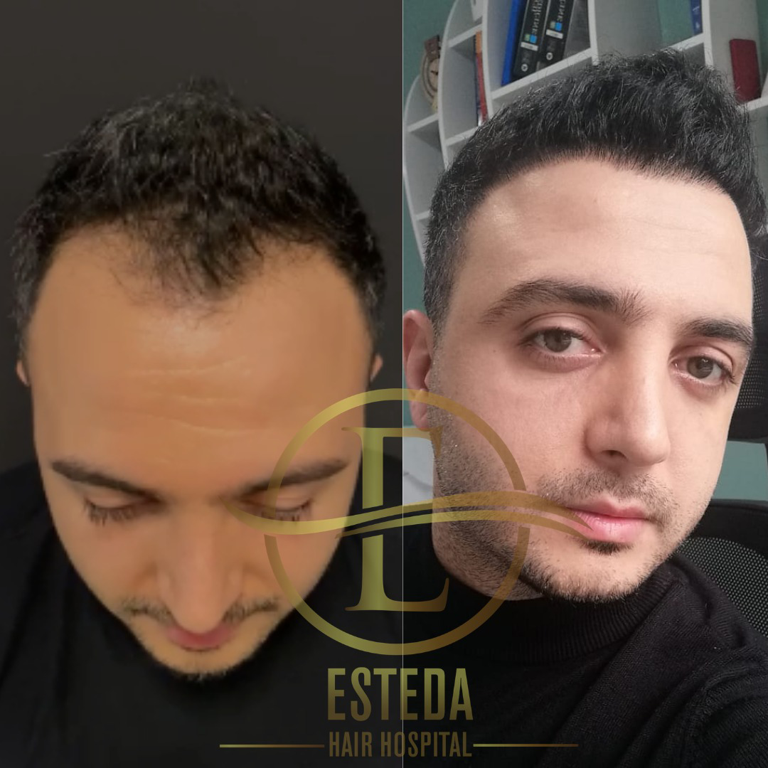 Saç Ekimi Öncesi Sonrası 10