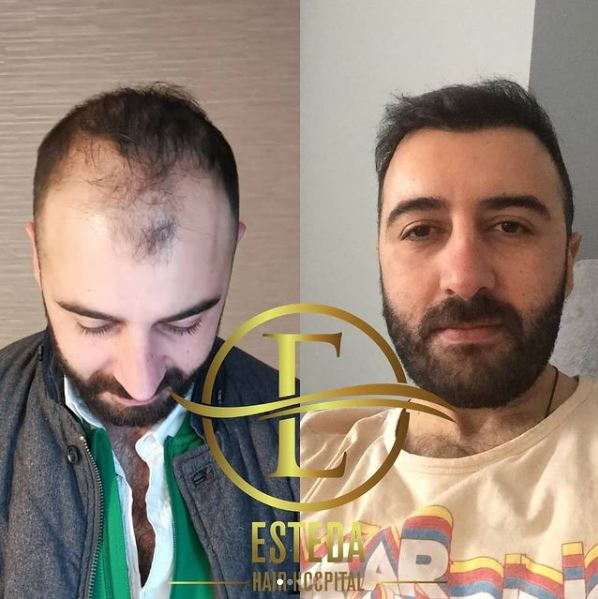 Saç Ekimi Öncesi Sonrası 16