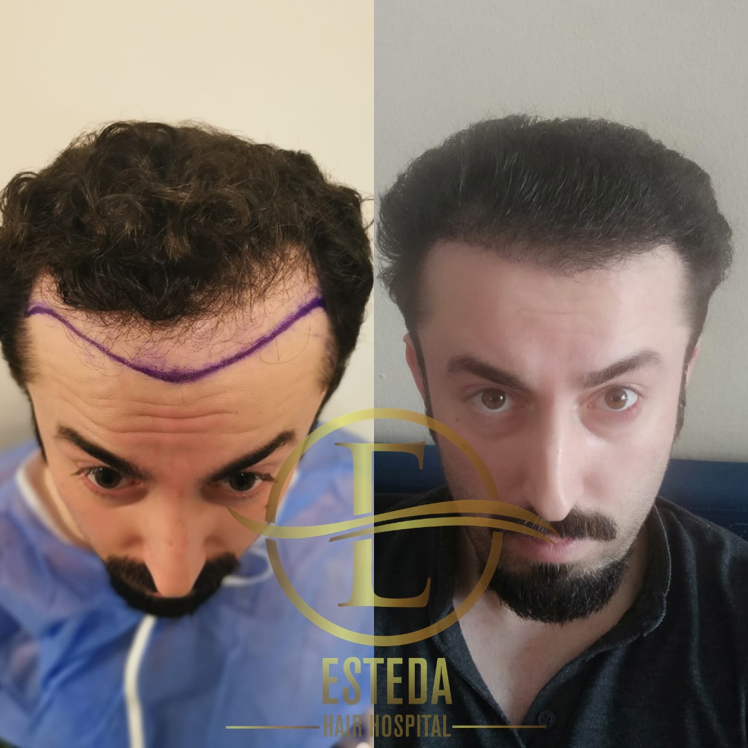 Saç Ekimi Öncesi Sonrası 13