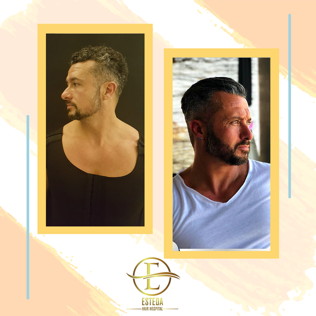 How Do We Do Beard Transplantation?